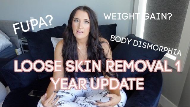 '1 YEAR POST OP- Skin Removal Update | Felicia Keathley'